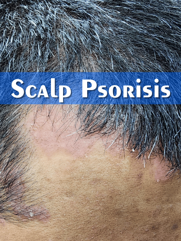 Scalp Psoriasis